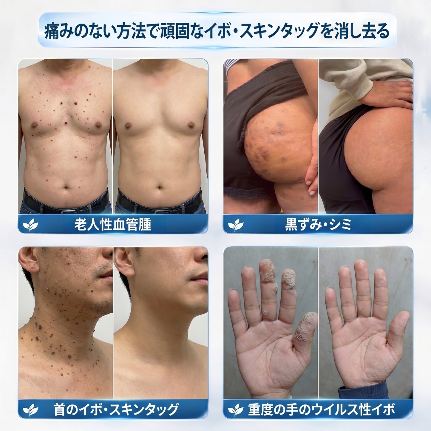 日本𝐏i𝐜𝐝o® 7日間 シミ取り 傷跡ケア ペン(痛みゼロ、傷ゼロのローラーボール)💪