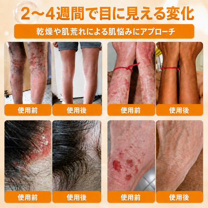 🔥🔥𝐃𝐨𝐫𝗺𝐨𝐫𝗻𝗮®公式ストア • 日本製 👑𝗗𝐨𝐫𝗺𝐨𝐫𝗻𝗮® 蜂毒配合オールインワンクリーム 🌟本日最終日 – 𝟖𝟎％OFF
